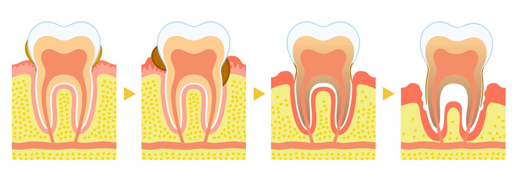 歯周病で歯を失うサイクル